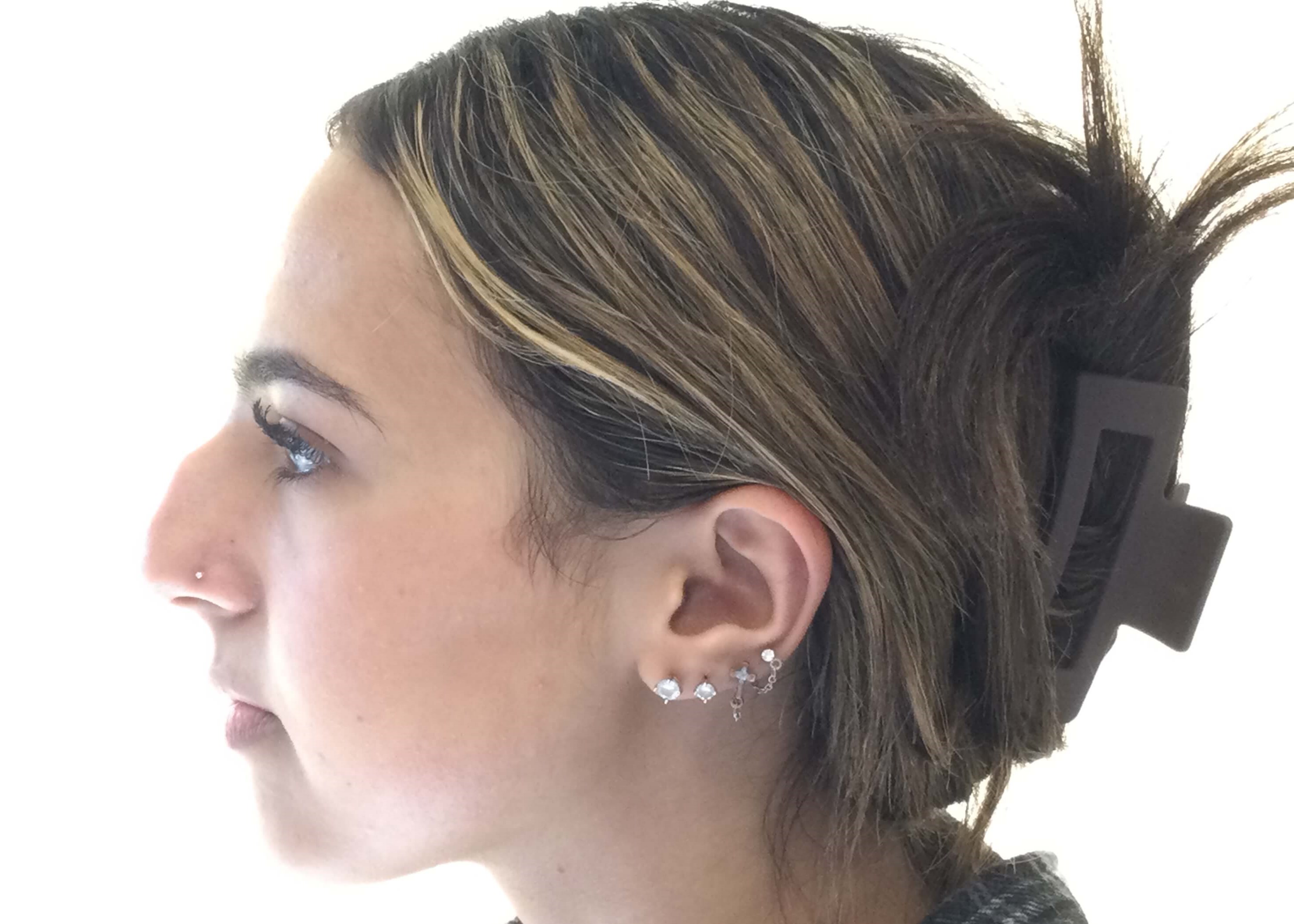 Dr Suzman Rhinoplasty